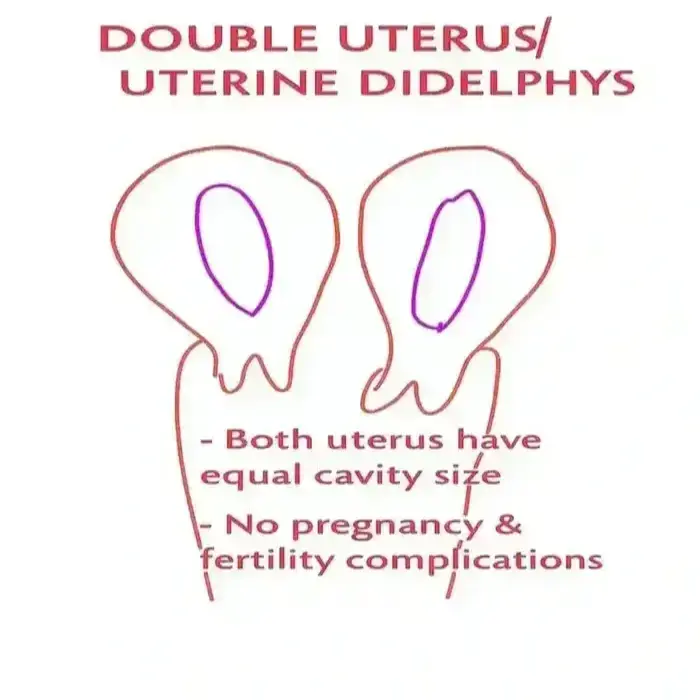 uterine didelphys