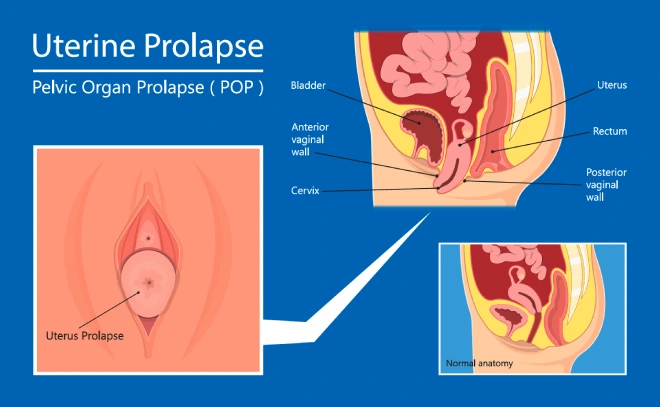 Uterine Prolapse (prolapsed uterus) – Pelvic organ prolapse